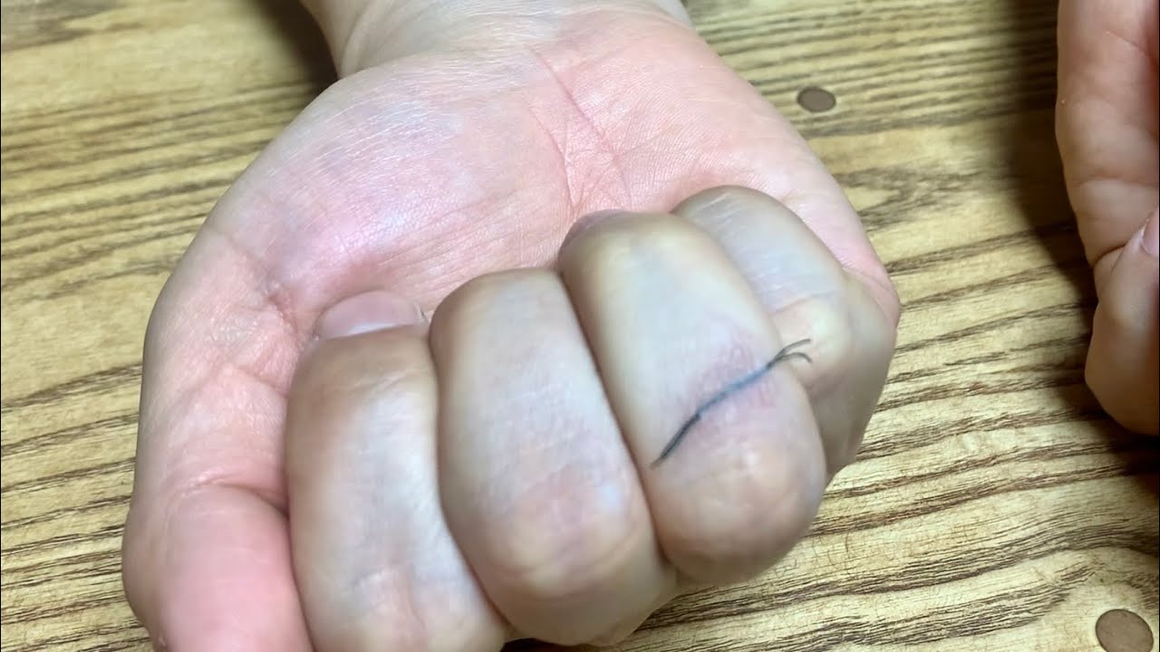 물집생겼을때 이렇게 하세요! (자막보기)