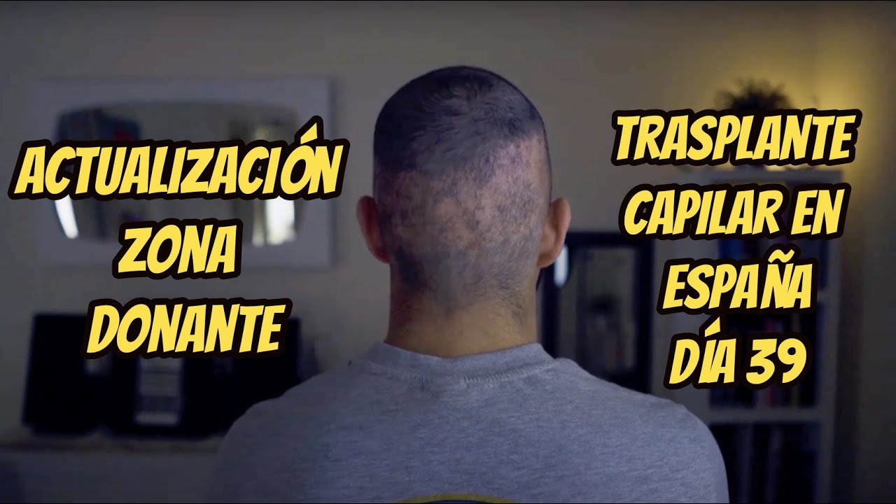Trasplante de pelo en España, Día 39