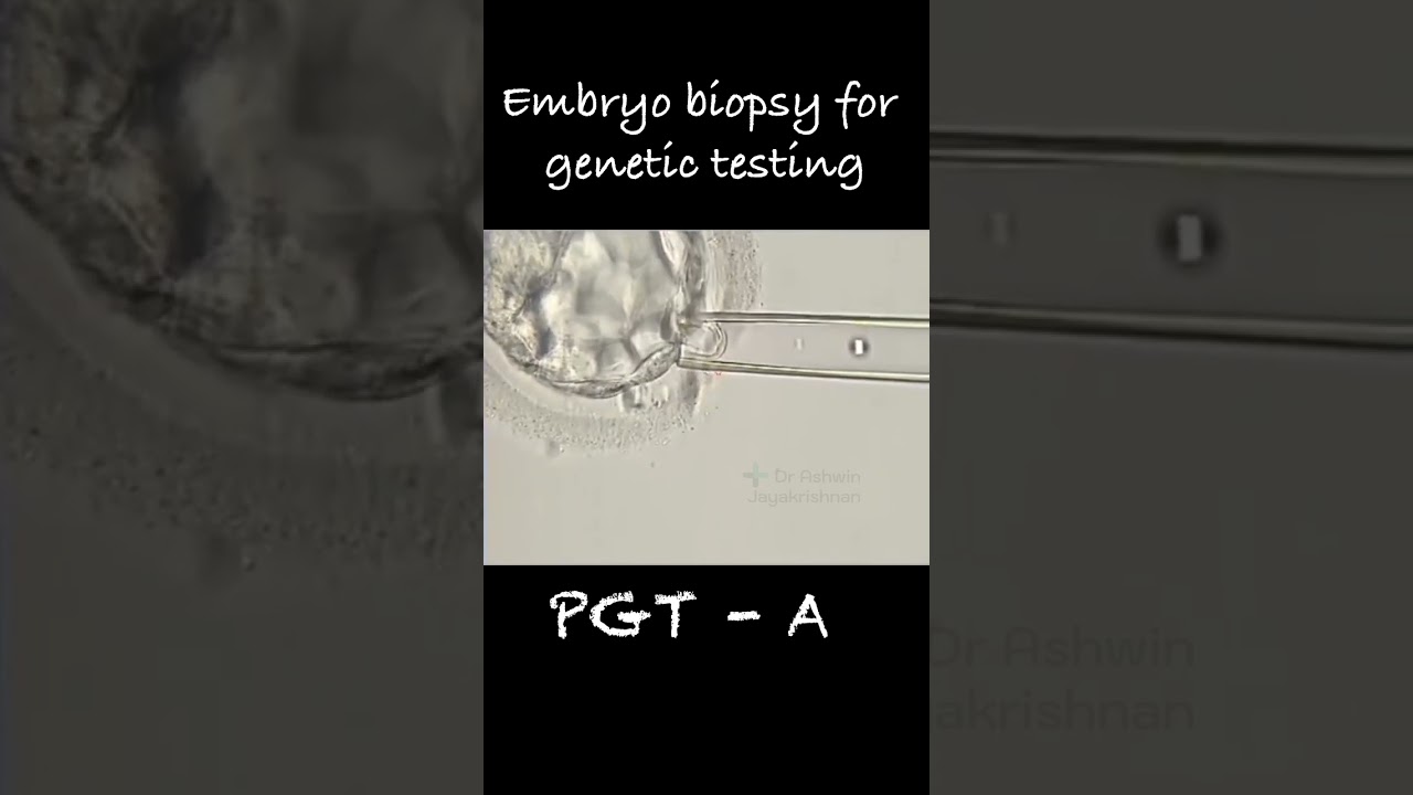 Embryo biopsy for genetic testing | PGT A | dr ashwin | kjk hospital | #ivf #infertility  #mom