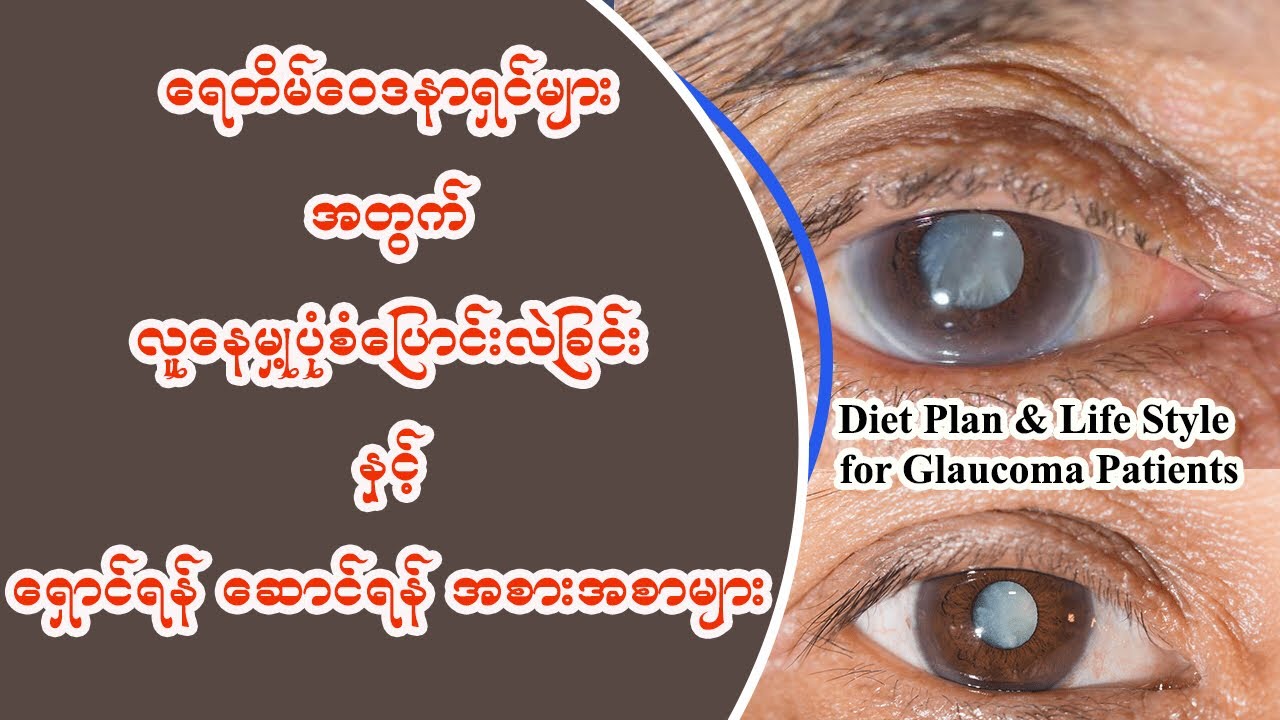 မျက်စိရေတိမ်ရှိသူတွေ ရေတိ​မ်လျော့ချဖို့ ဆောင်ရန်ရှောင်ရန်များ - Diet Plan & Life Style for Glaucoma