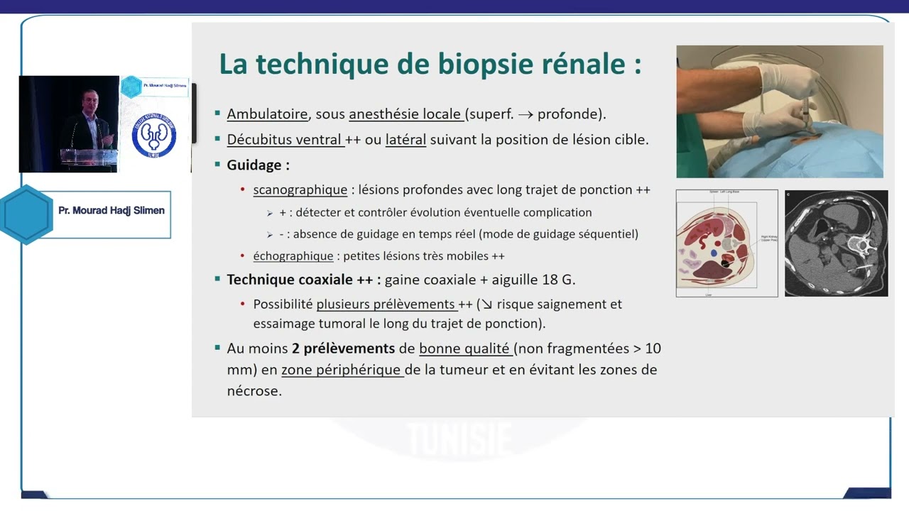 Cancer du rein : y’a-t-il une place à la biopsie ?