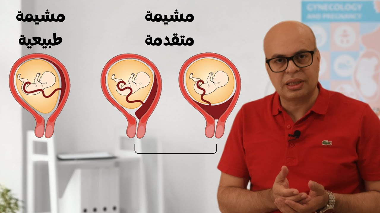المشيمة المتقدمة و 4 حاجات تعمليها لو عندك مشيمة متقدمة - د. أحمد كساب