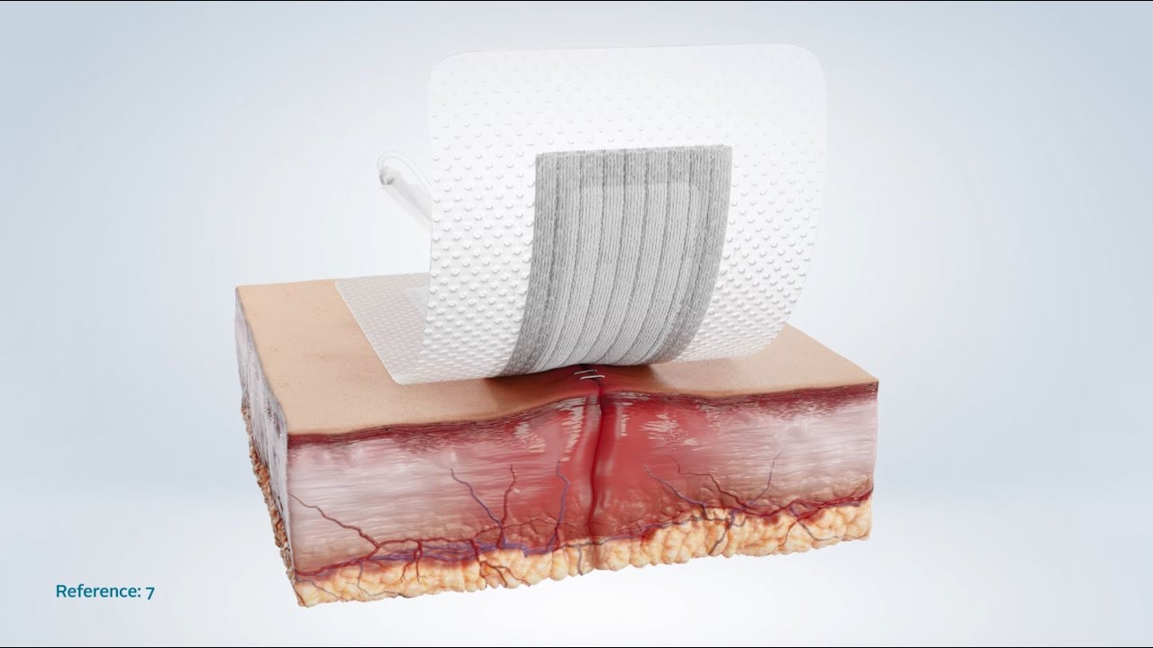 Avelle™ NPWT System Mode of Action - NPWT & Hydrofiber® Technology Explained