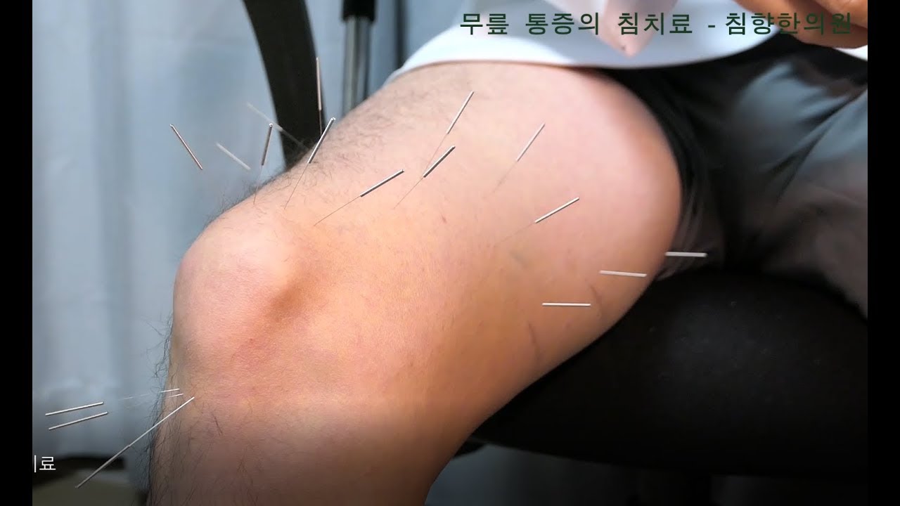 무릎이 아파서 한의원에 가면? - 무릎통증의 침치료