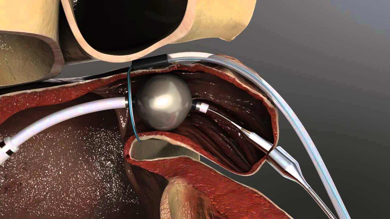 Left Atrial Appendage Occlusion | Westchester Medical Center
