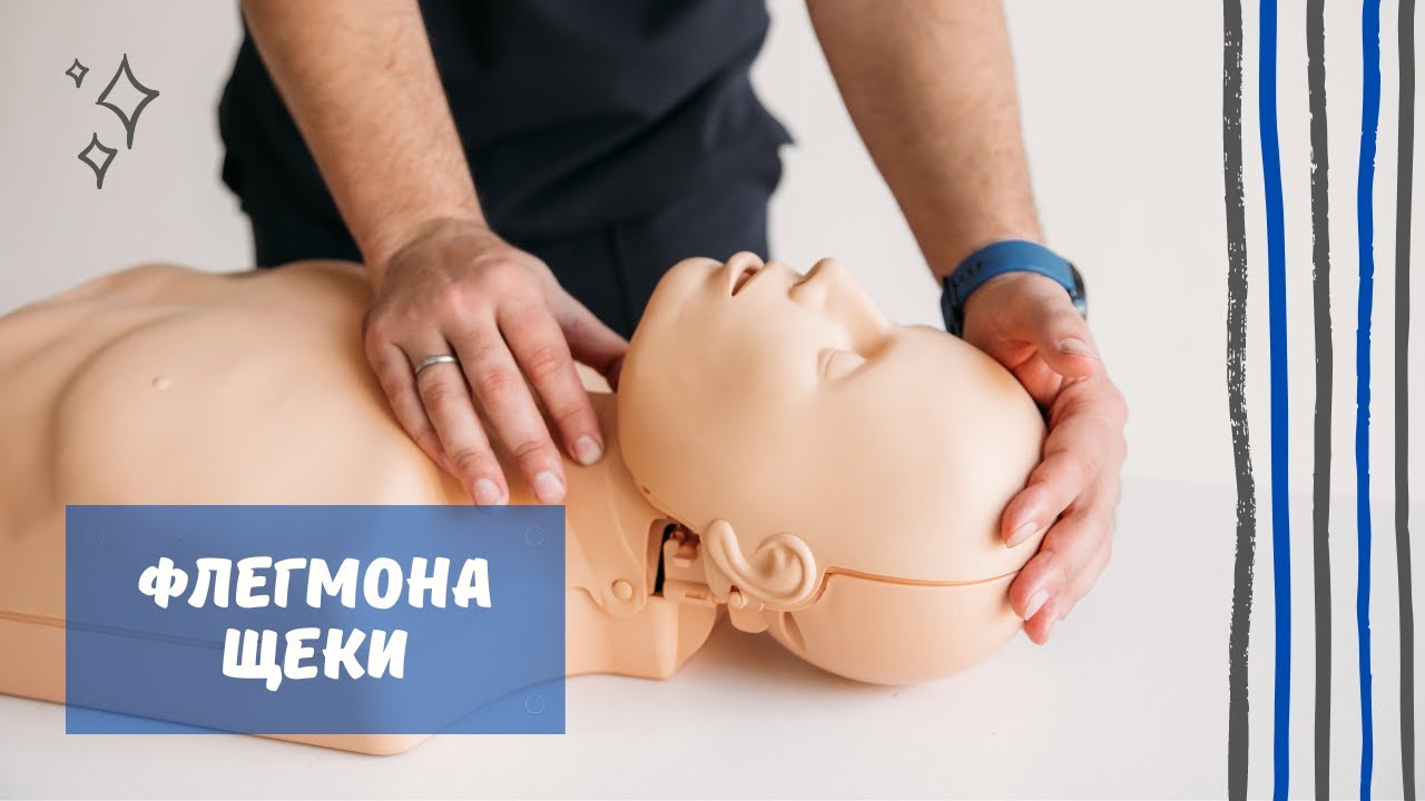 Флегмона щеки