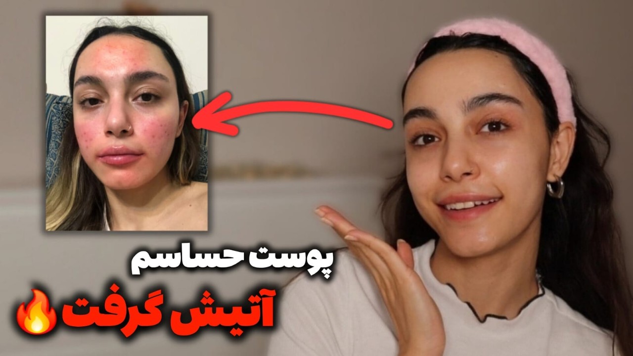 اگر پوست حساسی داری این ویدیو رو ببین🚨روتین پوستی و اشتباهاتی که کسی نمیگه‼️