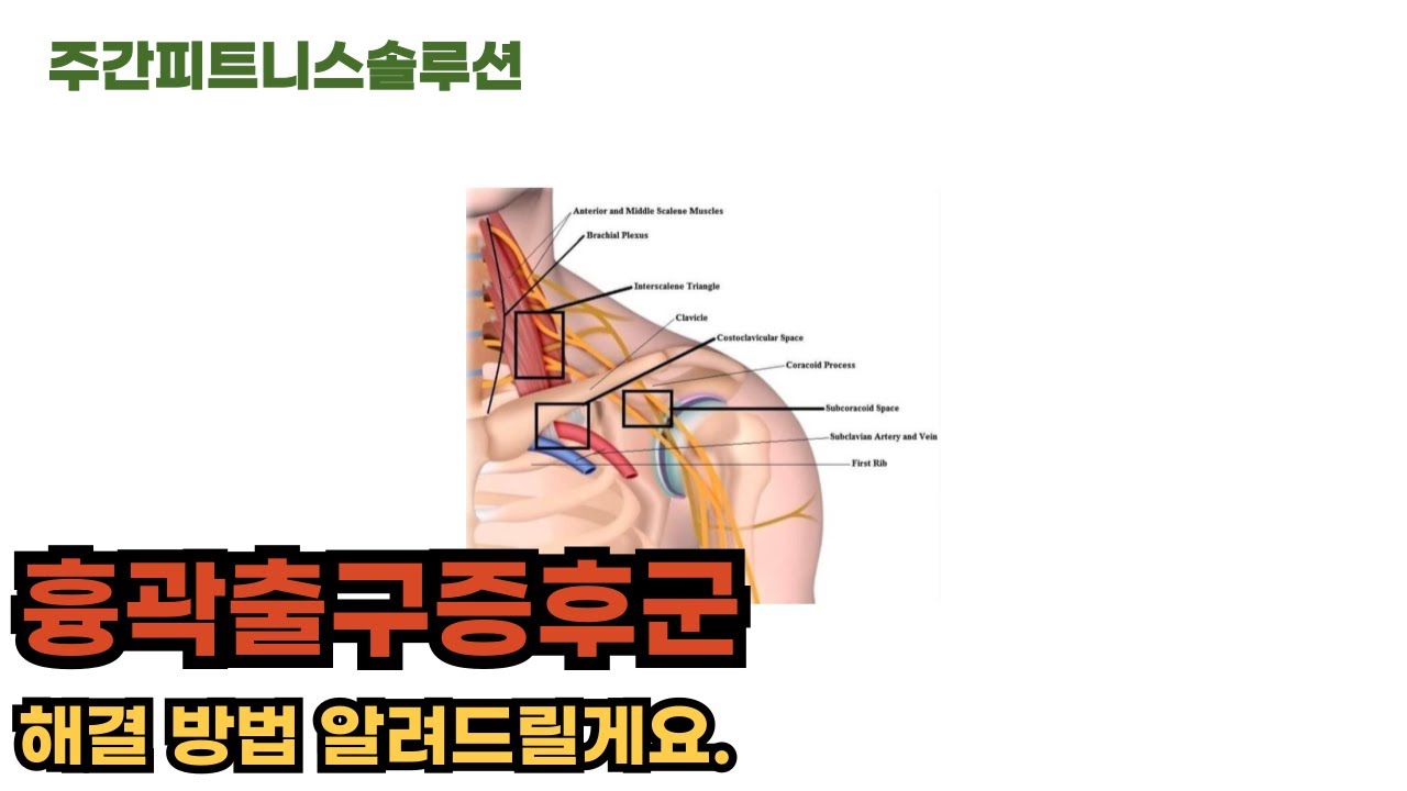 흉곽출구증후군 운동 어떻게 하는지 알려드릴게요.