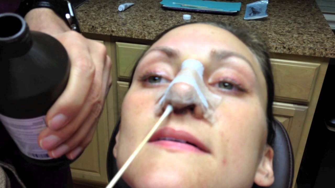 Rhinoplasty Recovery: (days 1 through 7) Nose Cleaning Instructions - Dr. Naderi