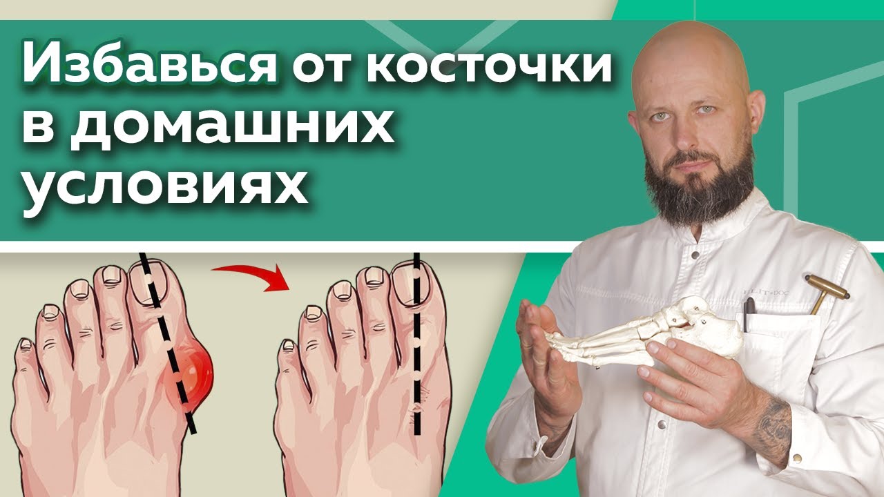 Как избавиться от шишки на ноге? / Эффективные упражнения для восстановления суставов