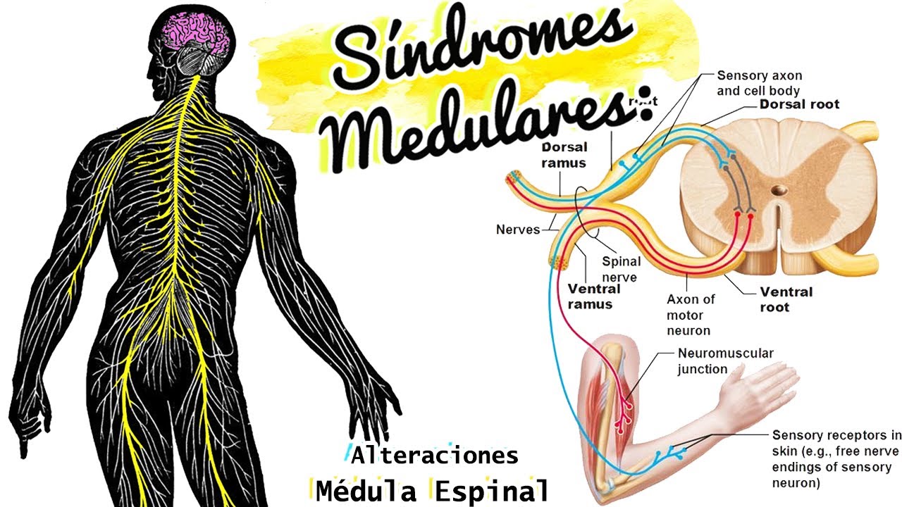 SÍNDROMES MEDULARES repaso y CASO CLÍNICO