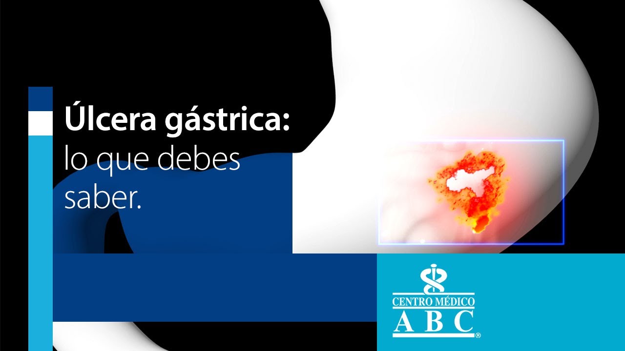 &Uacute;lcera g&aacute;strica: s&iacute;ntomas y tratamiento