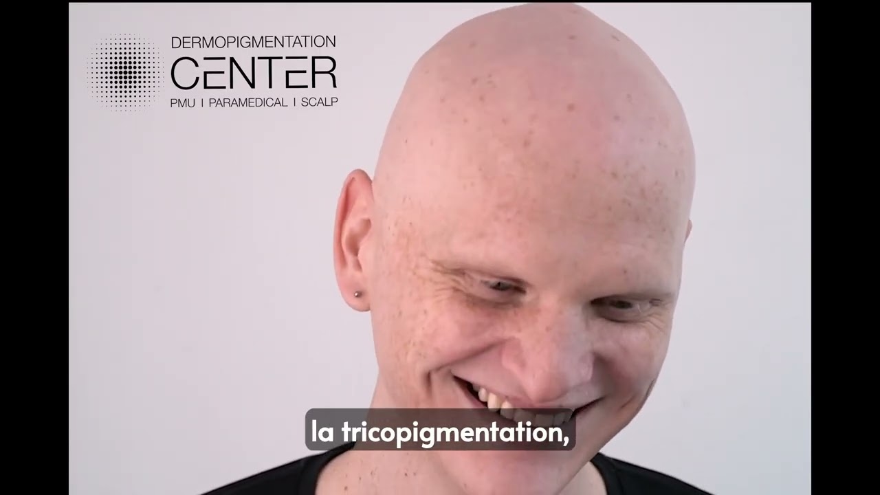Mathieu partage son expérience face à son alopecie universelle