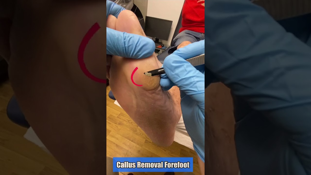 Ultimate Callus Removal on Forefoot by Top Australian Podiatrist | Ergonx Expert Techniques!