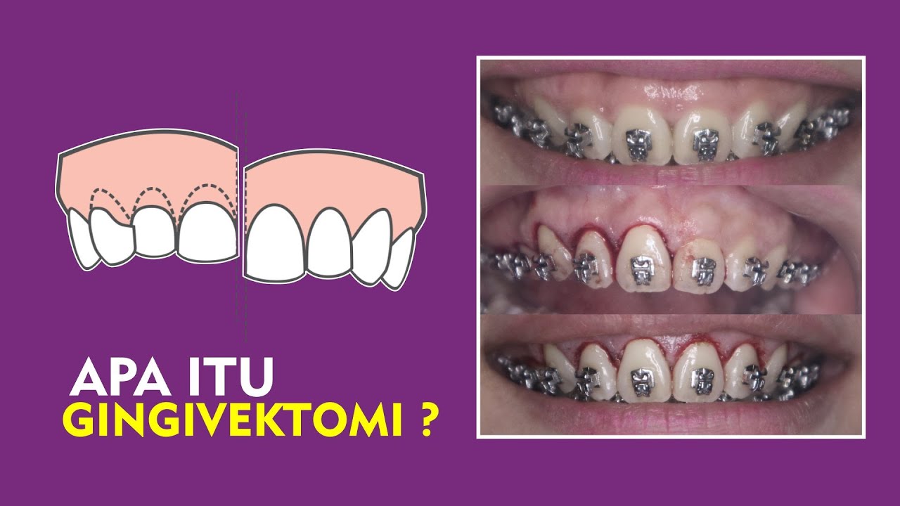 GINGIVEKTOMI Perawatan untuk Memperbaiki Gummy Smile