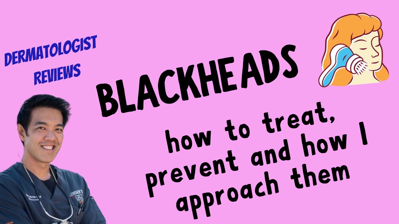 BLACKHEADS | Dermatologist discusses how to PREVENT & TREAT