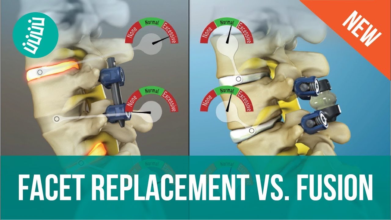 Facet Joint Replacement Vs. Spine Fusion