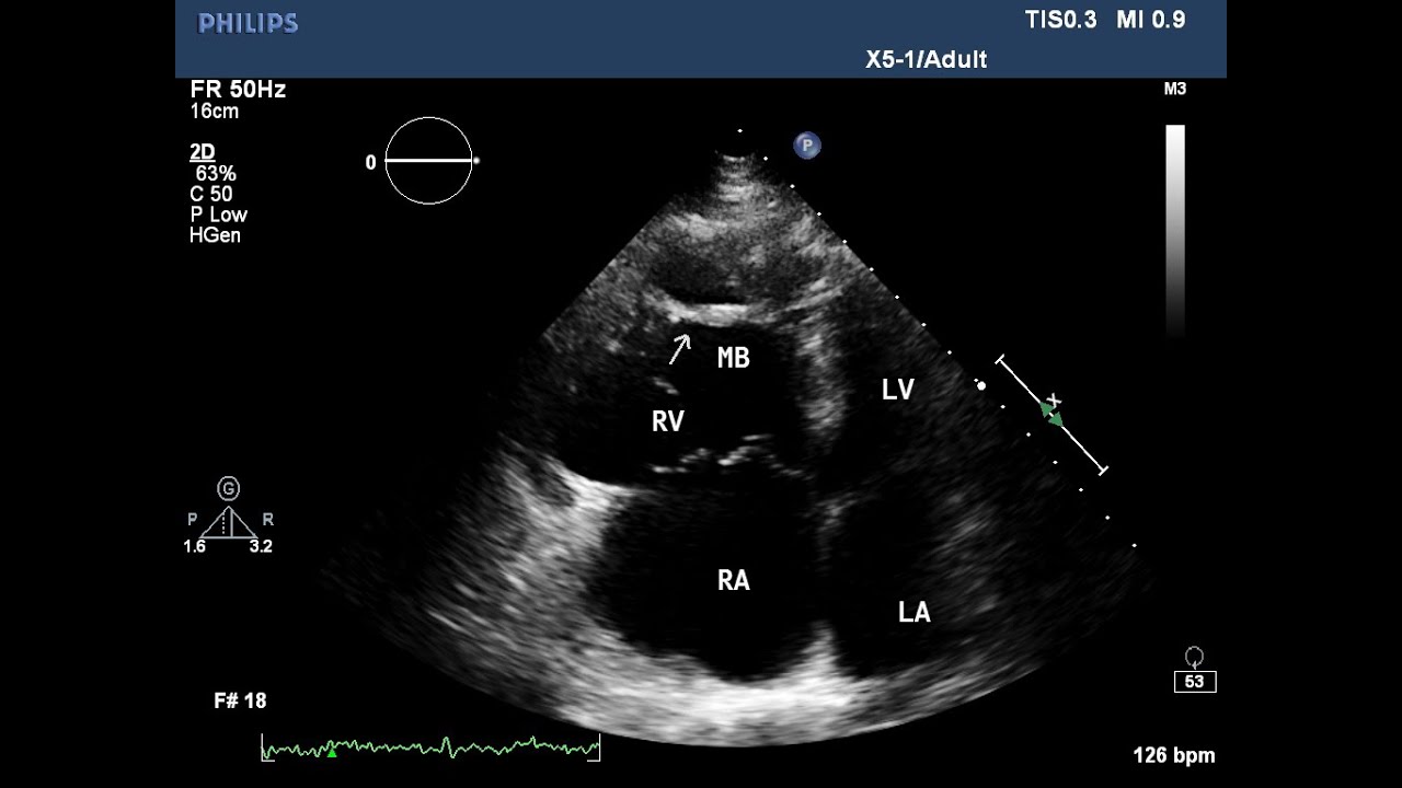 Typical Appearance for arrhythmogenic right ventricular dysplasia/cardiomyopathy(ARVD/ARVC)