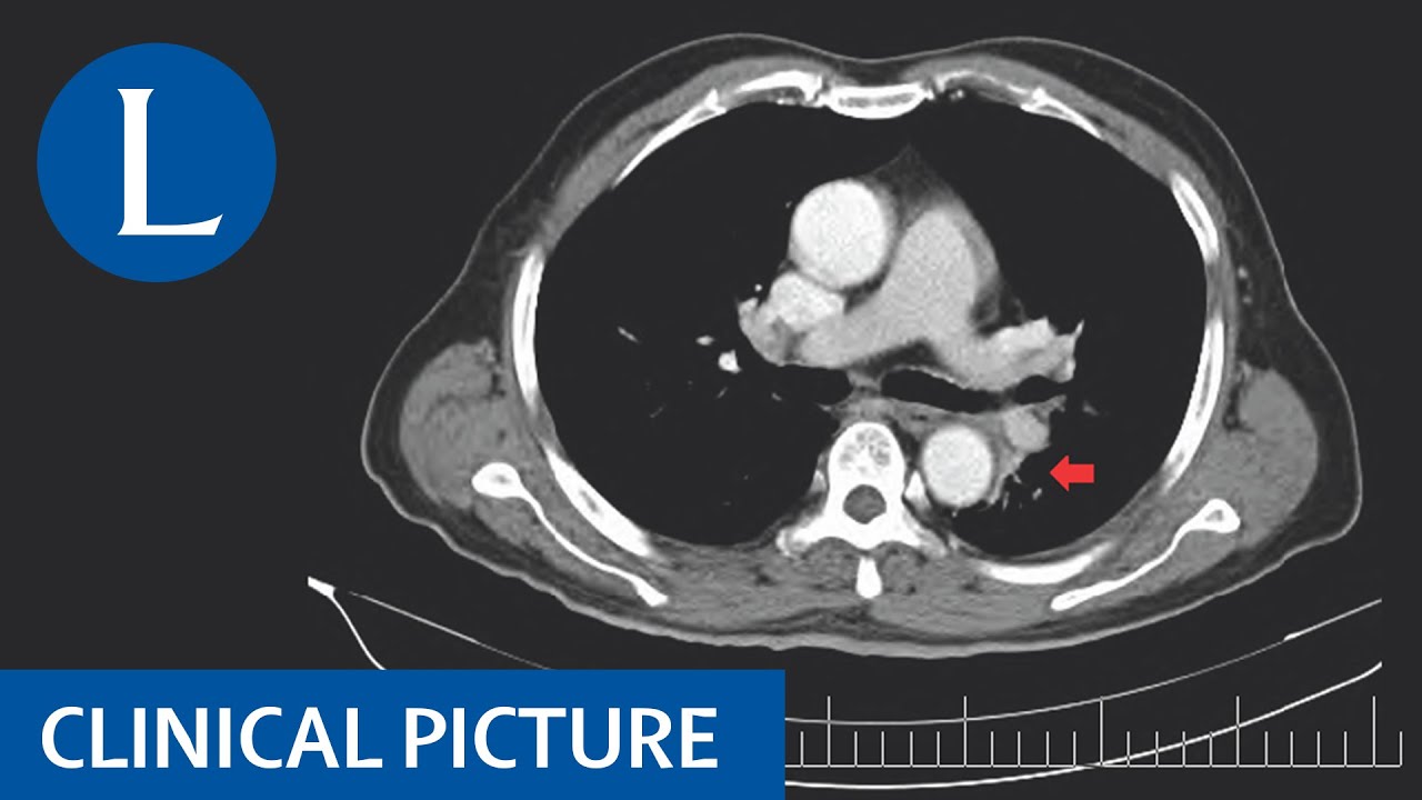 Diagnosing a mediastinal mass
