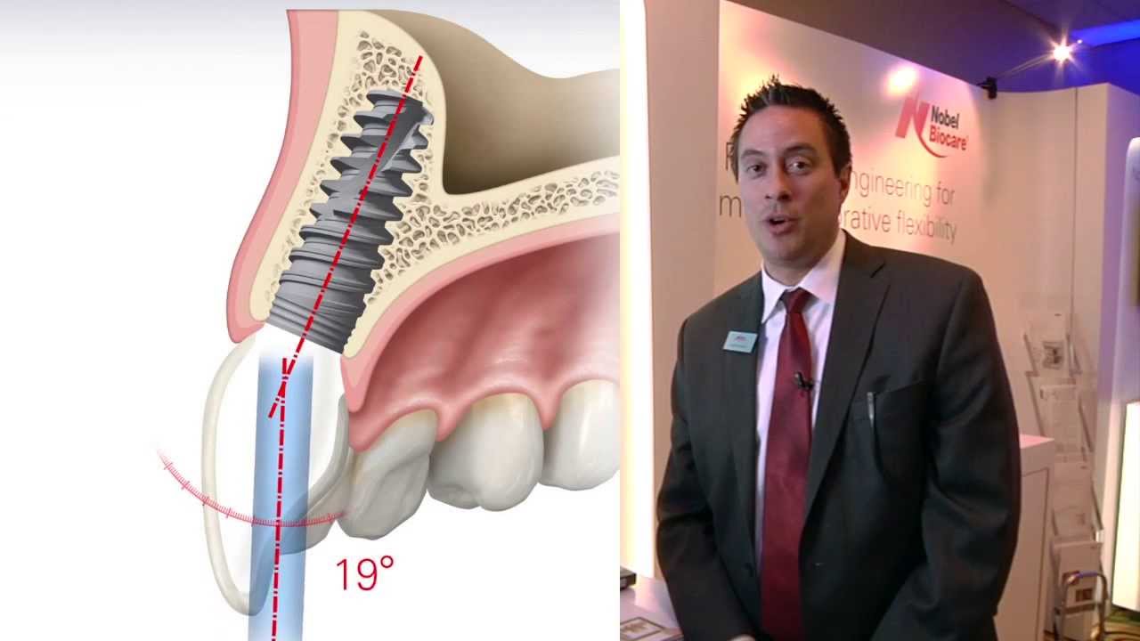 Angulated Screw Channel with Omnigrip