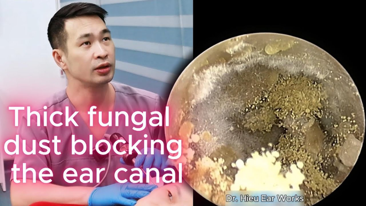 Thick fungal dust blocking the ear canal | ear cleaning | ASMR earwax | soothing | relax |