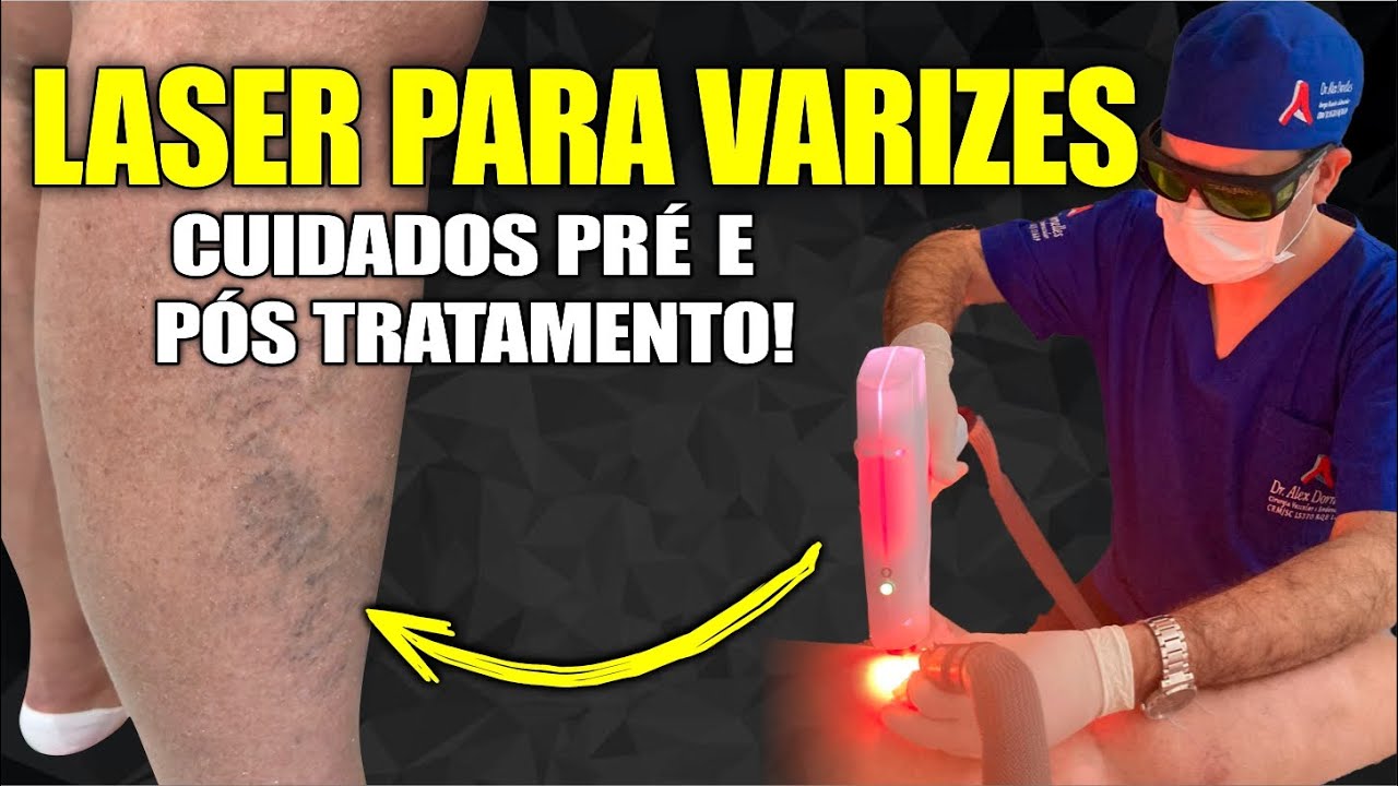 Veja: LASER TRANSD&Eacute;RMICO para VARIZES, cuidados no tratamento das VARIZES.