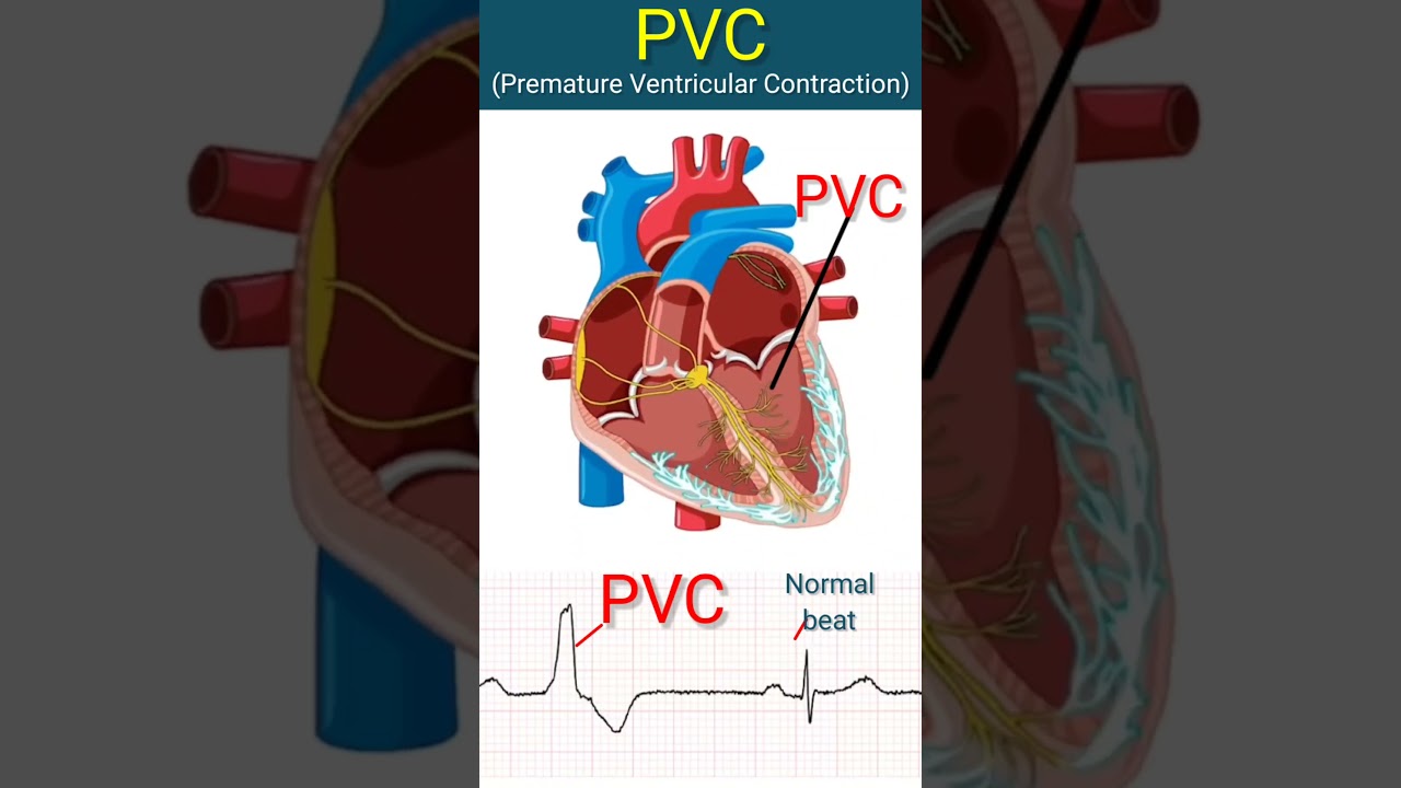 Heart with PVCs l #heart #ecg #shorts