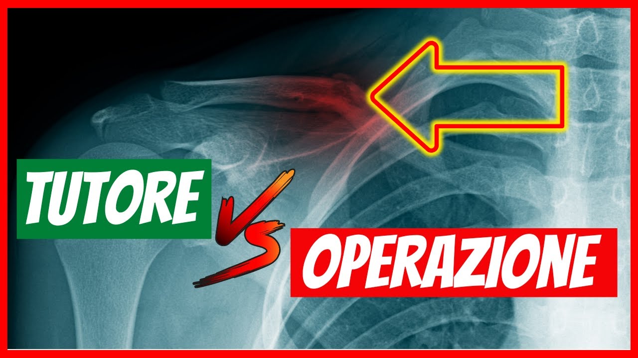 Frattura di CLAVICOLA - quando trattarla chirurgicamente e quando conservativamente