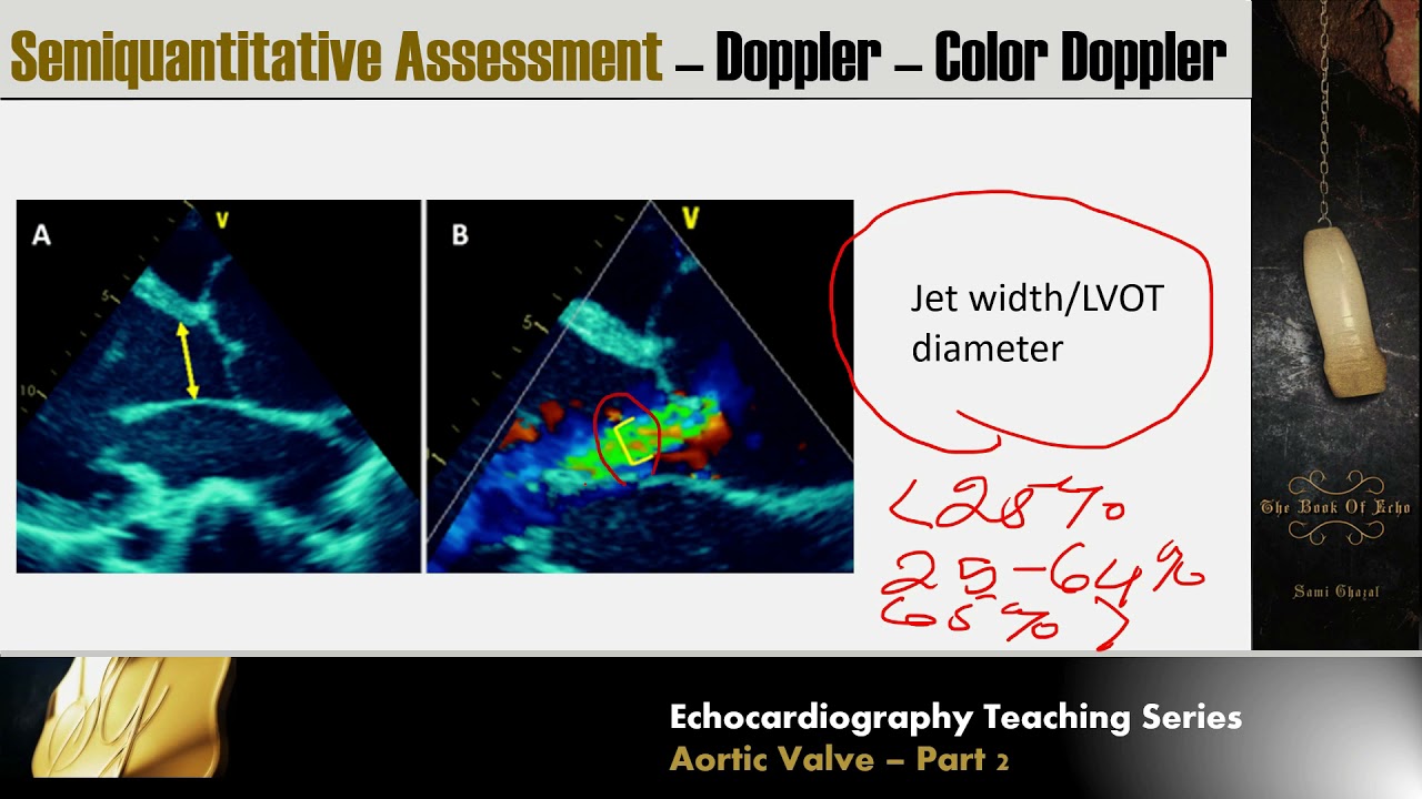 Lecture 10 - Aortic Valve Part 2