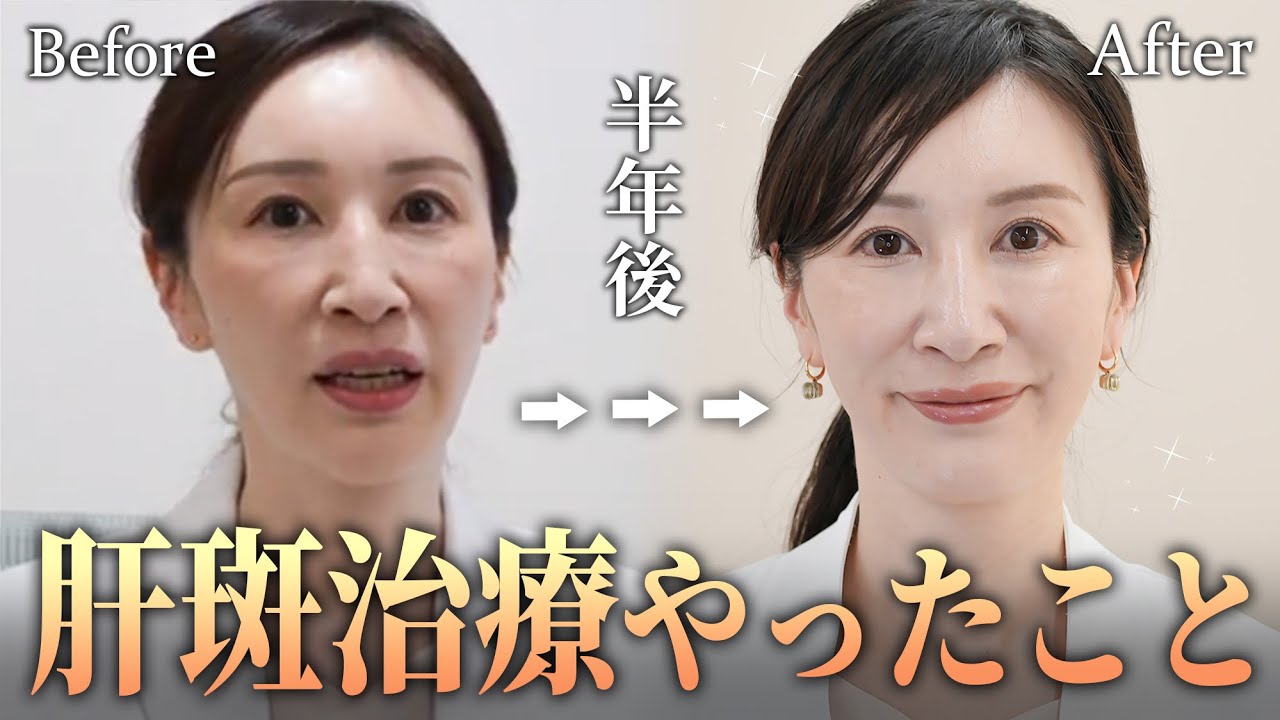 【ホームケア】悩んでいた肝斑が治療で改善しました！医師おすすめの“スキンケア”を紹介します【肝斑・シミ治療】
