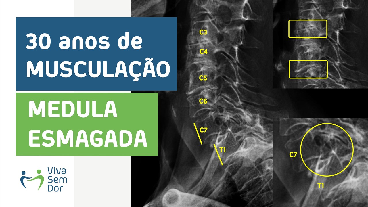 Recupere força e firmeza das pernas descomprimindo a medula  🧠🚶‍♂️