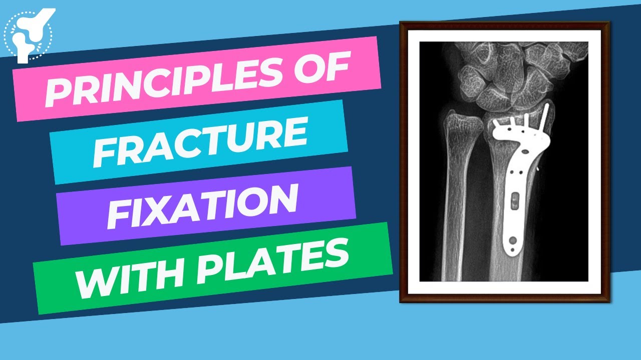Principles of Fracture Internal Fixation With Plates and Screws | Material Properties