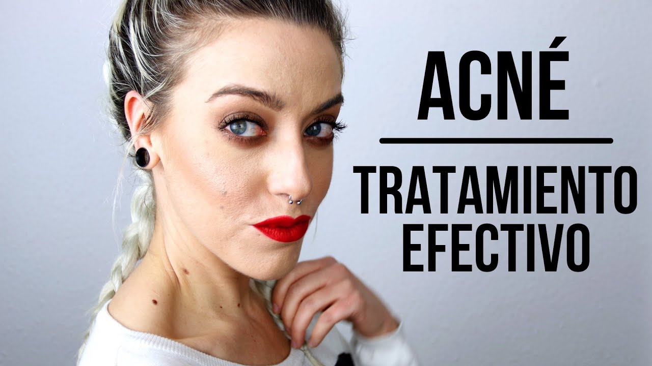 COMO ELIMINAR EL ACNÉ | Mi secreto para curar el acné quístico