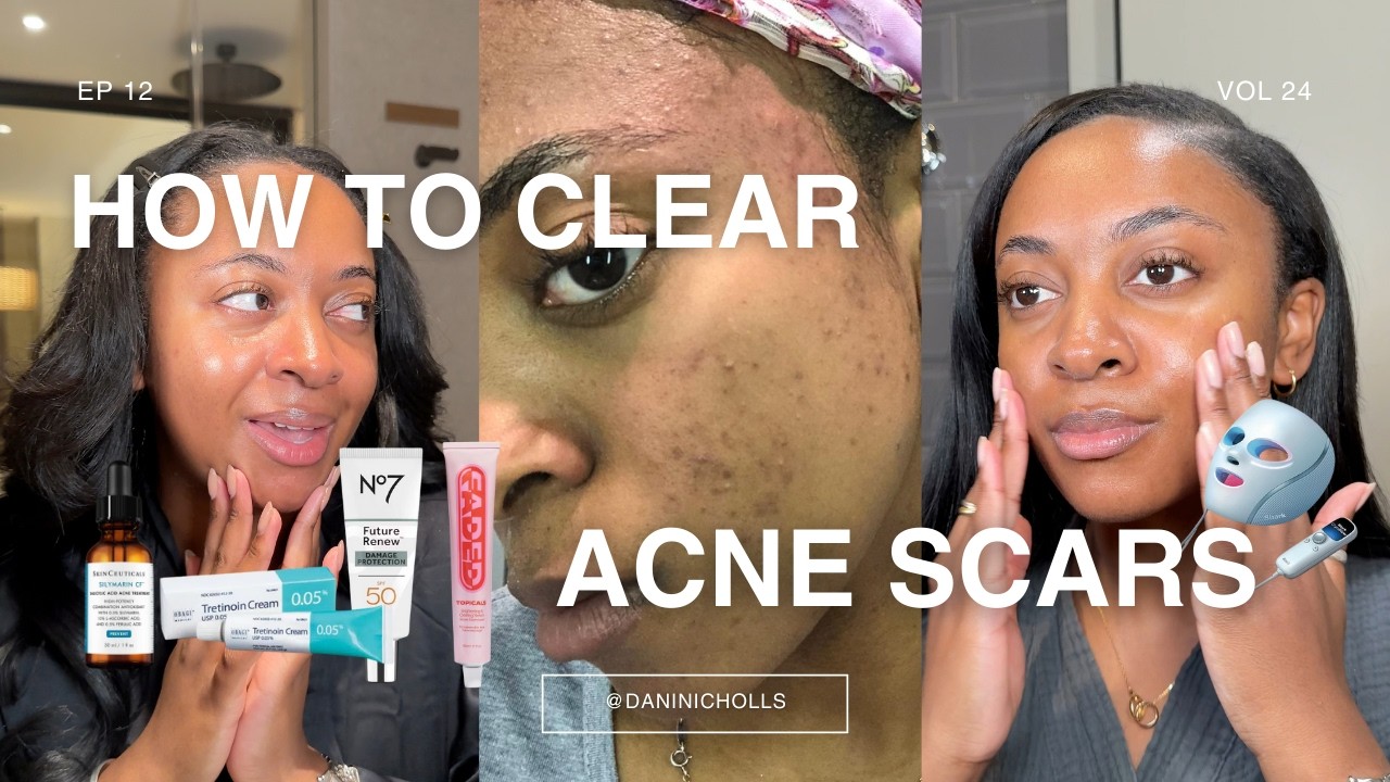 how to clear acne + acne&nbsp;scars | my acne journey, acne black skin, tretinoin, epiduo review + tips