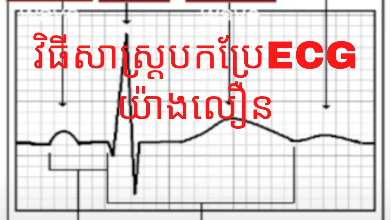 វិធីសាស្ត្របកប្រែECG យ៉ាងលឿន