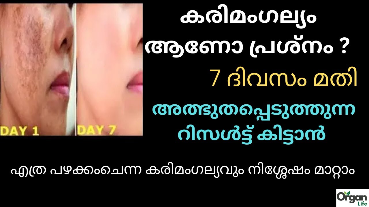 എത്ര പഴക്കംചെന്ന കരിമംഗല്യവും നിശ്ശേഷം മാറ്റാം,ആവണക്കെണ്ണ ഇങ്ങനെ ഉപയോഗിച്ചാൽ |ORGANLIFE