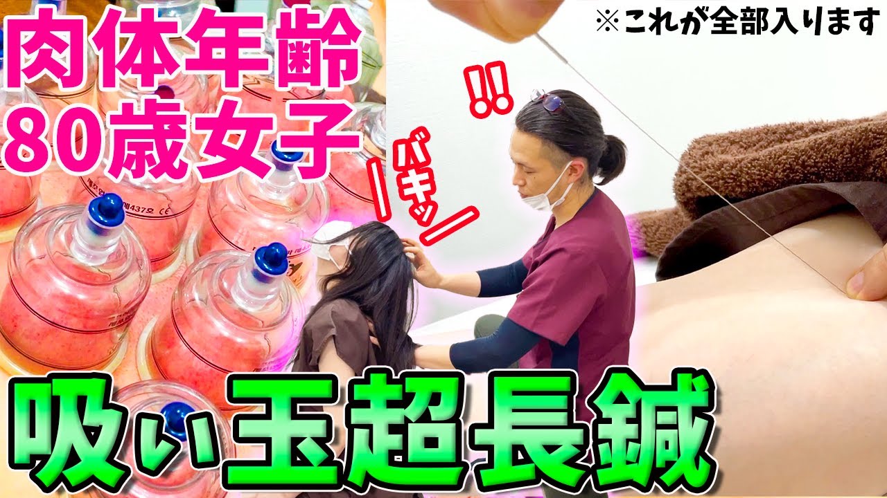 【吸い玉 肩こり】肩こりに悩む女子に吸い玉と超長鍼！肉体年齢80歳な交通事故多めな女子が初めての吸い玉を受けてみました