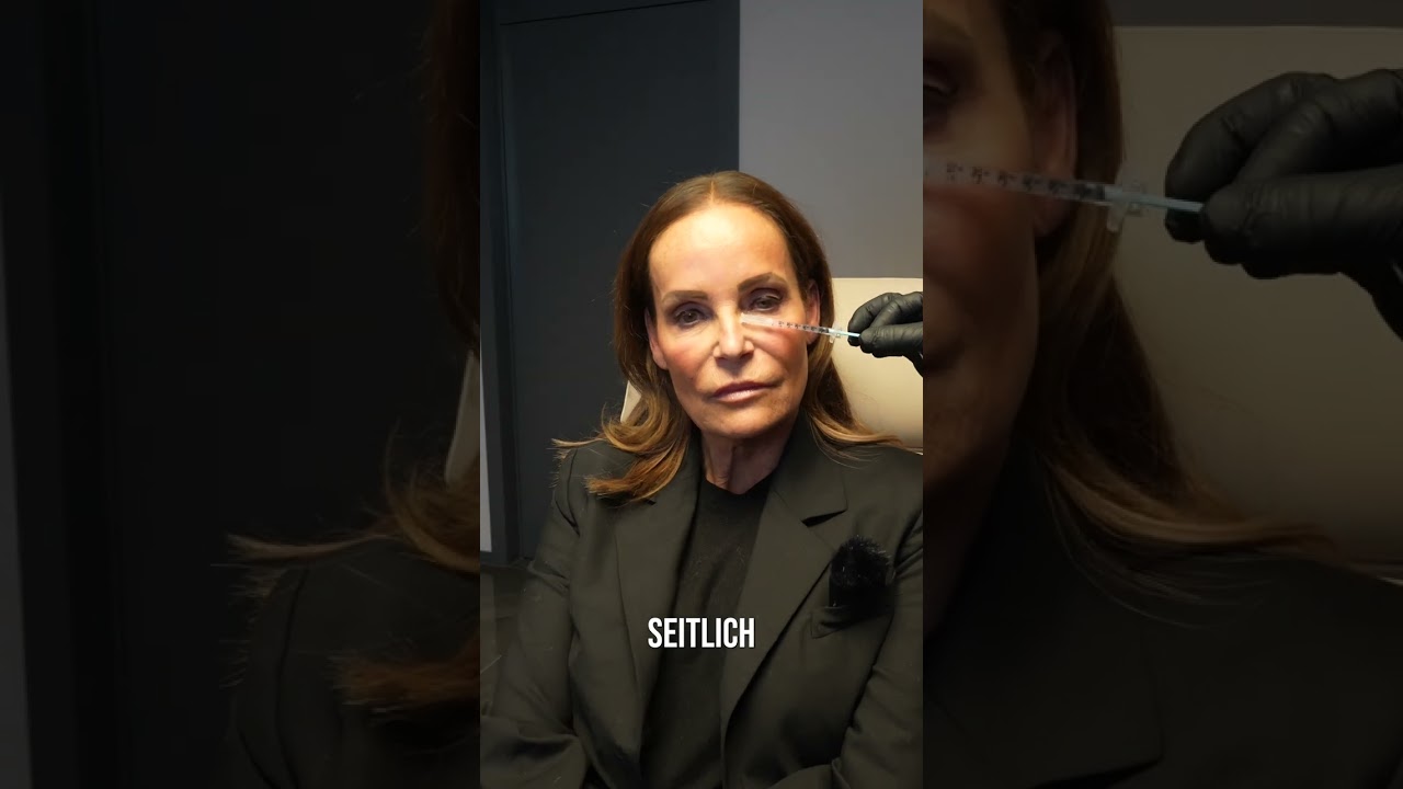 Sculptra, Botox & Temples bei DR. NICK