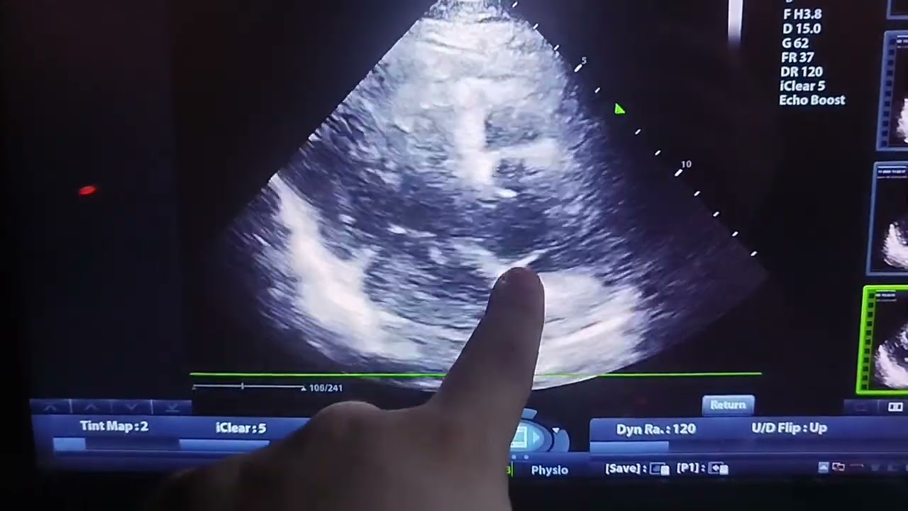 Acute Aortic Dissection&Acute Aortic Regurge , Transthoracic Echocardiography shows Dissection flap 
