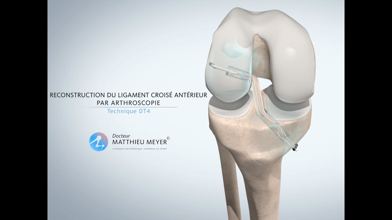 LIGAMENTOPLASTIE DU LIGAMENT CROISÉ ANTÉRIEUR PAR ARTHROSCOPIE (TECHNIQUE DT4) - DR MATTHIEU MEYER