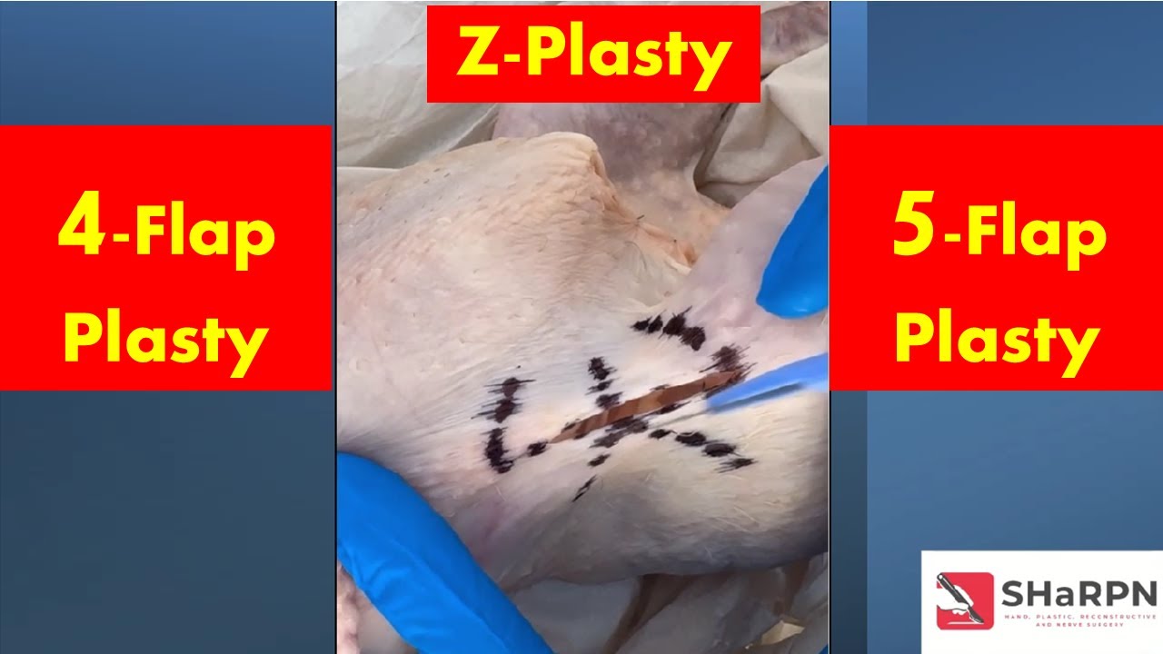 Mastering Plastic Surgery Techniques: Z-plasty, 4-Flap & 5-Flap plasty explained with chickens!