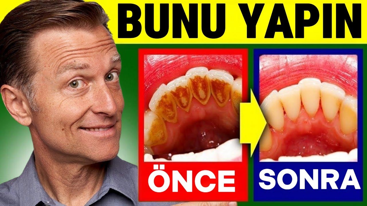 Diş Plağına, Çürüklere ve Diş Eti Sorunlarına Karşı Doğal Yöntem | Dr. Berg Türkçe