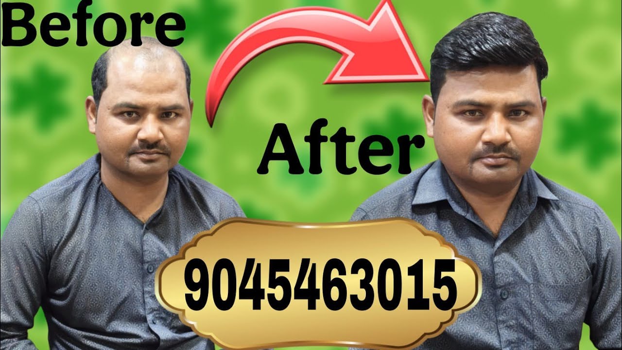 गंजापन का समाधान | Hair wig hair patches for men in  mathura |#hairwig#hairwigformen #hairwigmathura