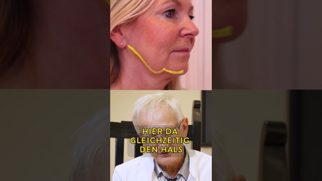 Facelift bei 51-j&auml;hriger Patientin Vorher & 5 Wochen nach OP! #facelift #plastischechirurgie