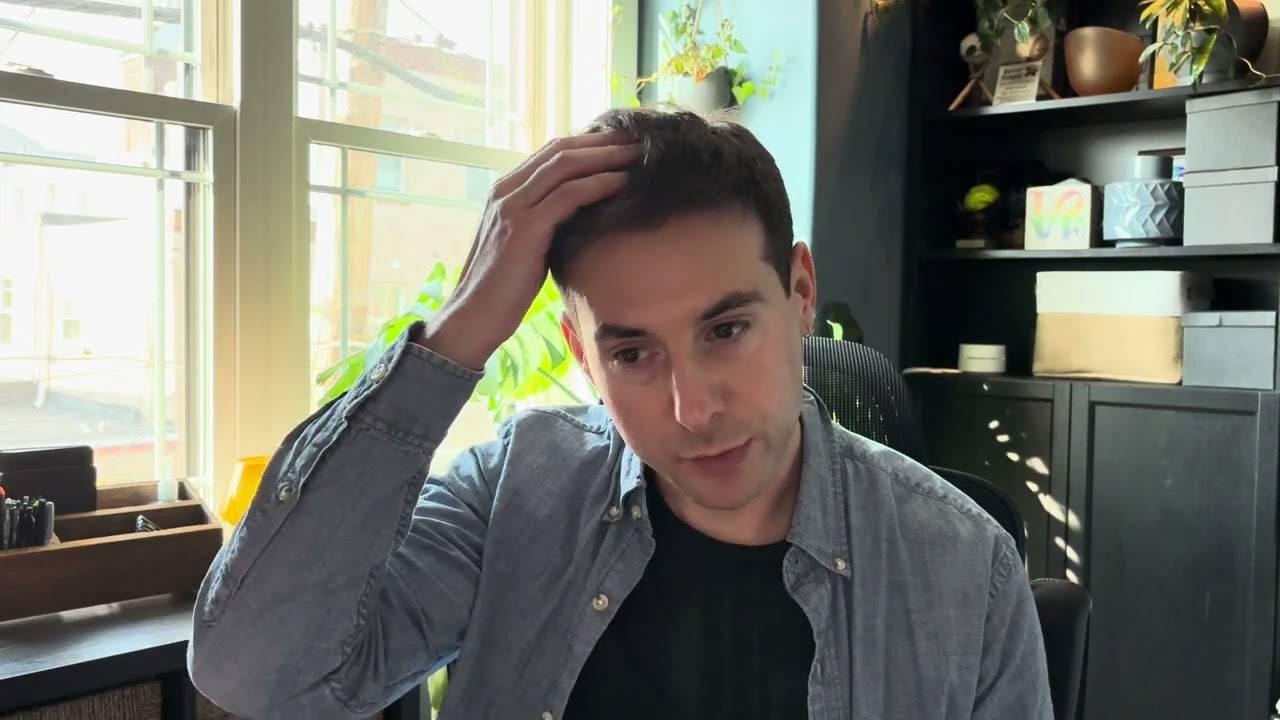 4,000 Grafts - 5 month update! Post hair transplant - Cosmedica Clinic in Istanbul with Dr. Acar