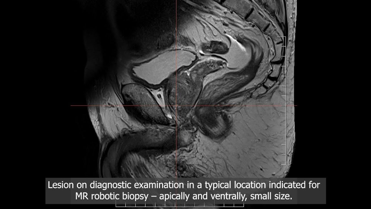 In-bore MR guided prostate biopsies