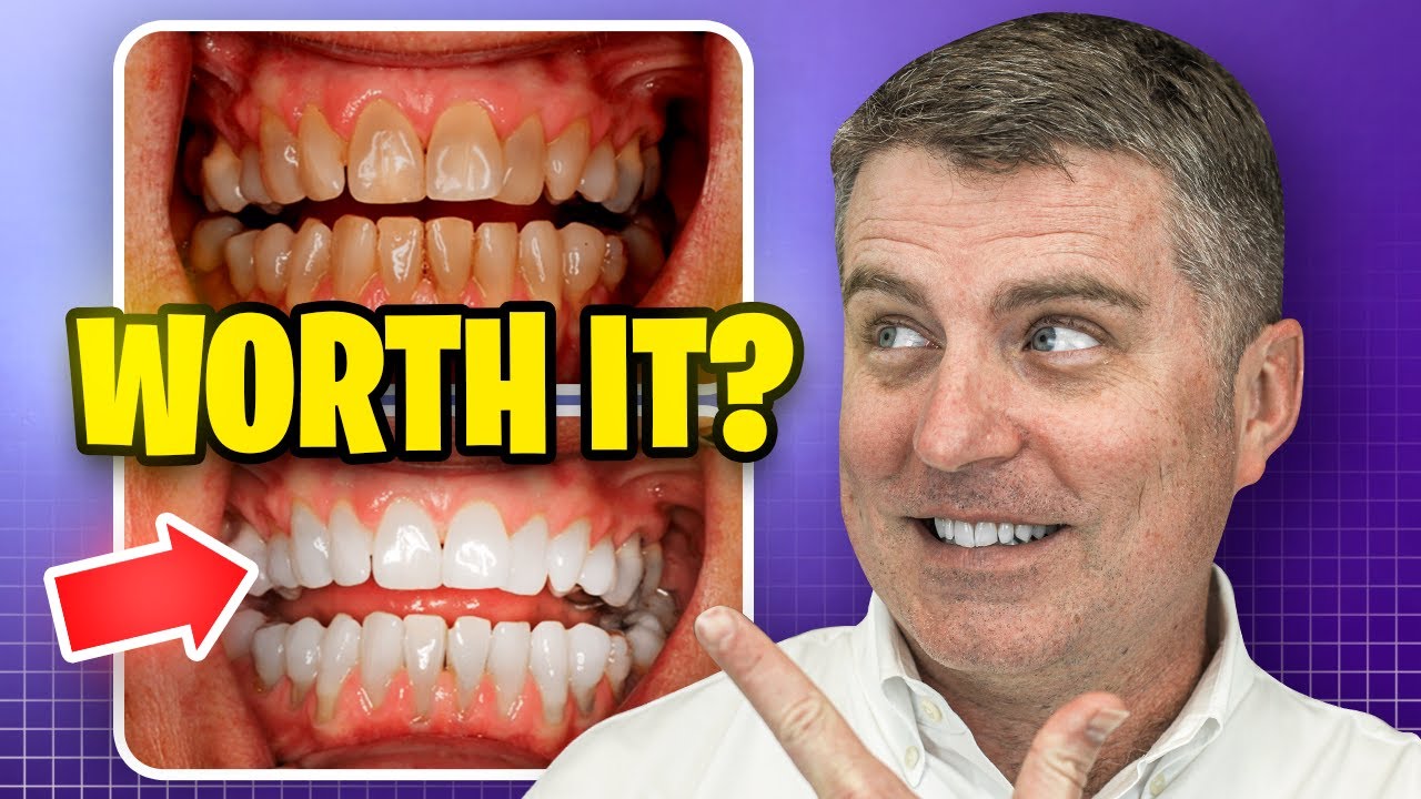How to Tell if You Actually Need KoR Whitening in San Antonio