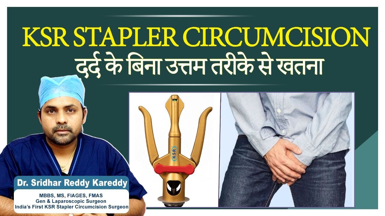 KSR Stapler Circumcision in India || Best Circumcision Technique in Hindi || Circum Cure Clinic