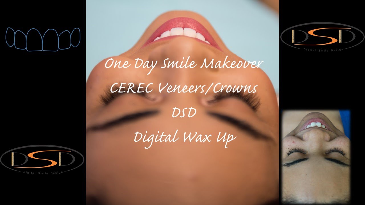 CEREC Omnicam DSD Veneers Crowns One day Smile Makeover