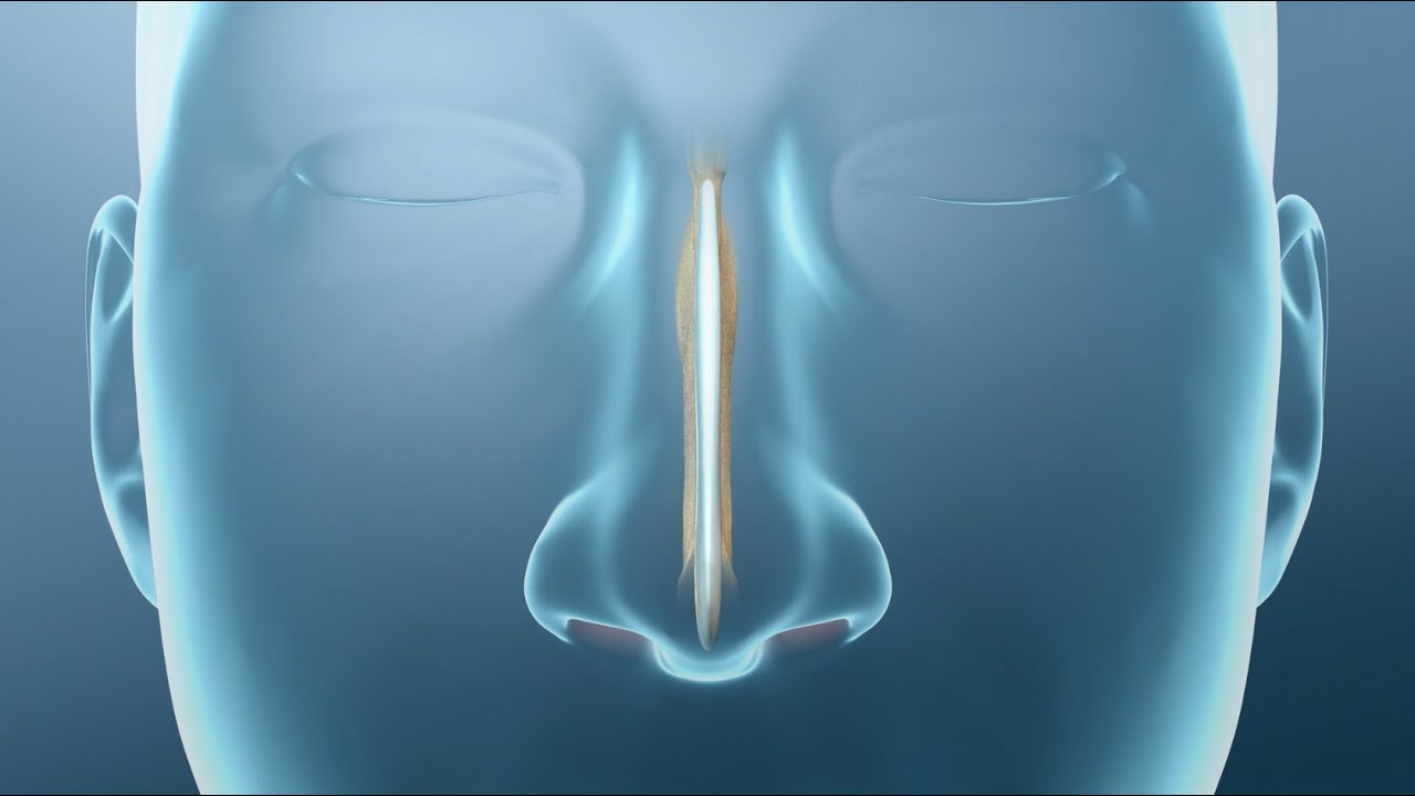 Cirugía plástica del tabique nasal